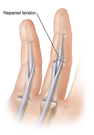 Palm view of hand showing sutures repairing cut flexor tendon.