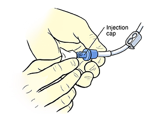 Closeup of gloved hands cleaning injection cap of central line with alcohol wipe.