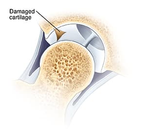 Cross section of hip joint with femoral head moved out of socket, showing damaged cartilage lining of socket. 