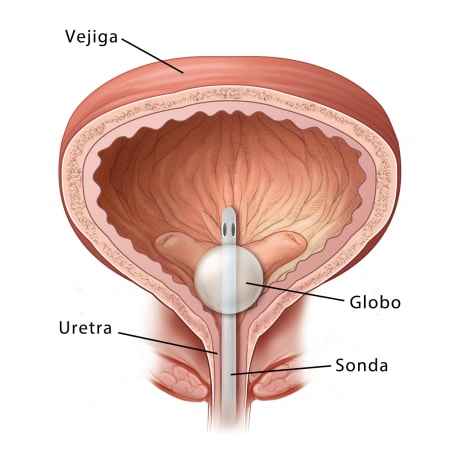 Corte transversal de la vejiga en el que se aprecia la sonda colocada.