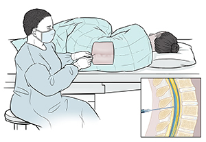 Proveedor de atención médica le inserta una aguja en la parte inferior de la columna vertebral a un paciente tapado y acostado de lado. El recuadro muestra un corte transversal de la columna lumbar con la aguja insertada en el conducto vertebral.