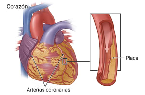 Corazón que muestra dos arterias coronarias, con detalle de arteria estrechada por placa.