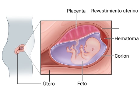 Ubicación del útero durante el embarazo y primer plano del feto, el corion, el revestimiento uterino y la placenta, con sangre entre el revestimiento uterino y el corion.