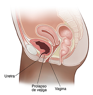 Seccion transversal de vista lateral de la pelvis femenina que muestra vejiga prolapsada (cistocele).