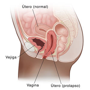 Seccion transversal de vista lateral de la pelvis femenina que muestra un útero prolapsado. 